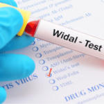 Widal blood test at home