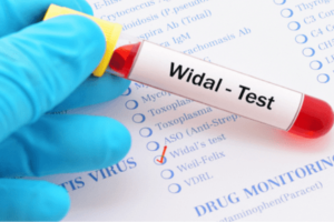 Widal blood test at home