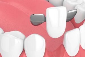 dental bridges in Leduc, AB