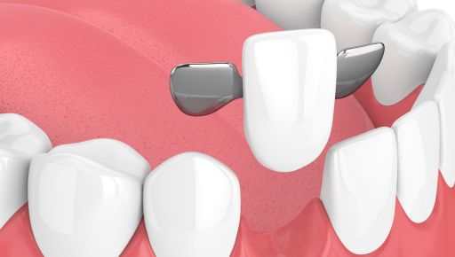 dental bridges in Leduc, AB