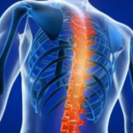 Spondylosis Treatment
